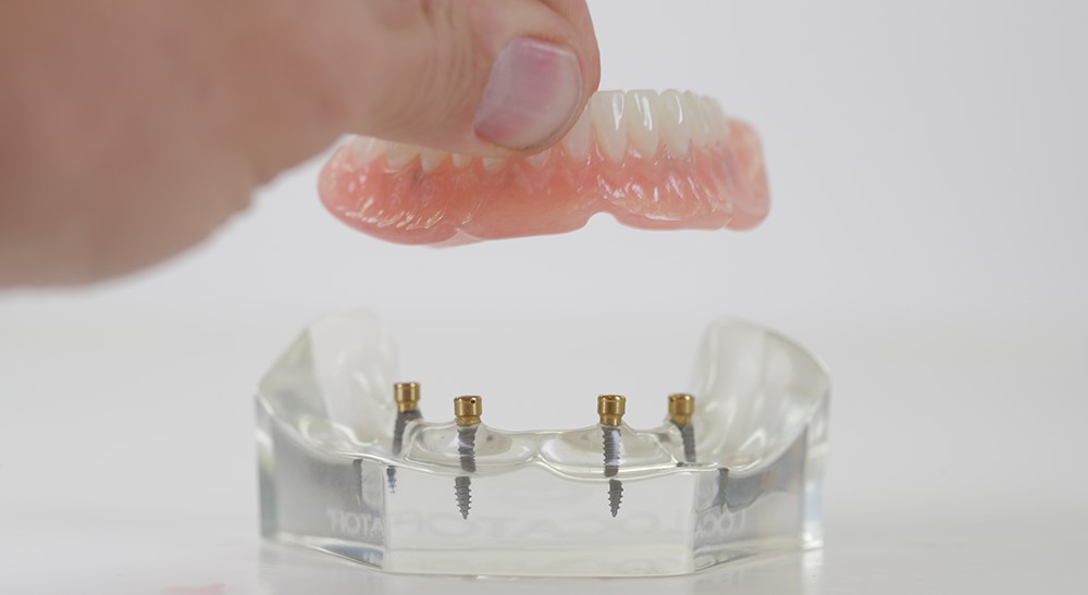 Occlusion In Complete Dentures Lancaster MO 63548